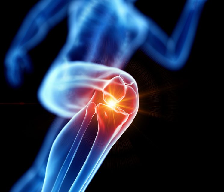 3d rendered illustration of a joggers painful knee