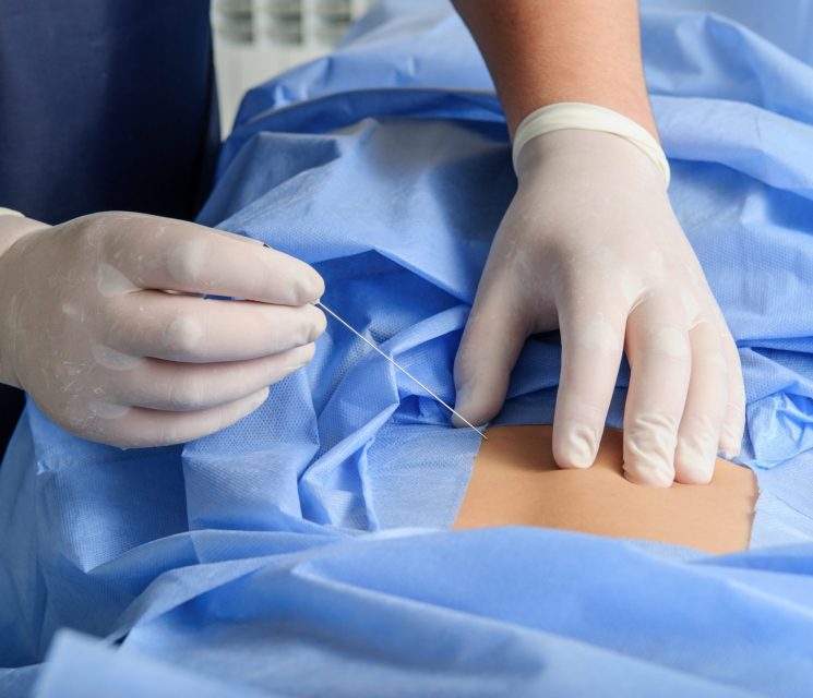 Doctor during spine operation in  operating room